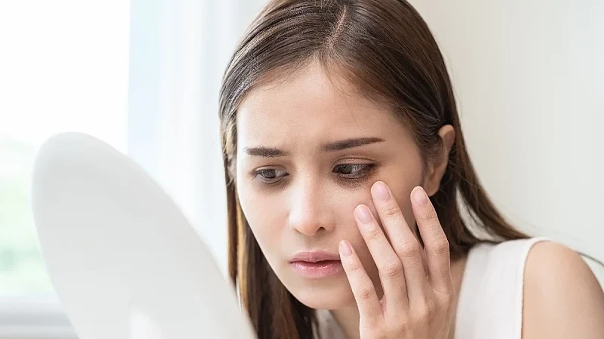 Mungesa e këtyre vitaminave mund të shkaktojë rrathë të errët nën sy