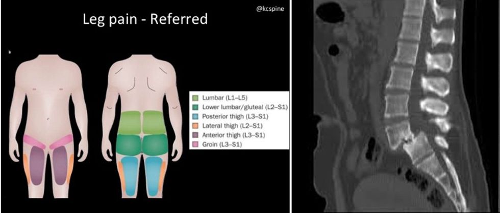 indications for surgery in adult spondylolisthesis 18 638