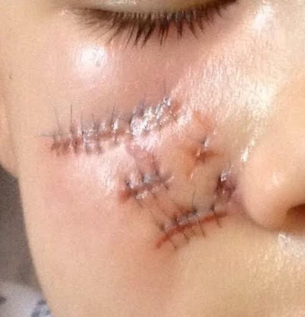 Injuries of the boy who can not be named after Digby the dog bit him during a selfie he was taking. See Masons copy MNBITE: These shocking pictures show the horrific injuries suffered by an 11-year-old boy after he was attacked by a dog as he took a Snapchat selfie of himself with it. The schoolboy was savaged by the animal called Digby as he snapped an image using the popular image messaging app. Digby sunk his teeth deep into his left cheek on January 9, leaving him needing 21 stitches and numerous hospital trips. Last week Digbyís owner, Stuart Harris, 45, pleaded guilty to having a dog dangerously out of control at Chelmsford magistrates' court in Essex.