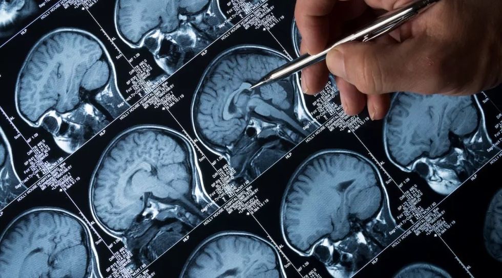 istock braintumor small