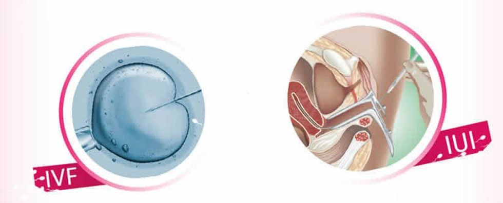 ivf iui