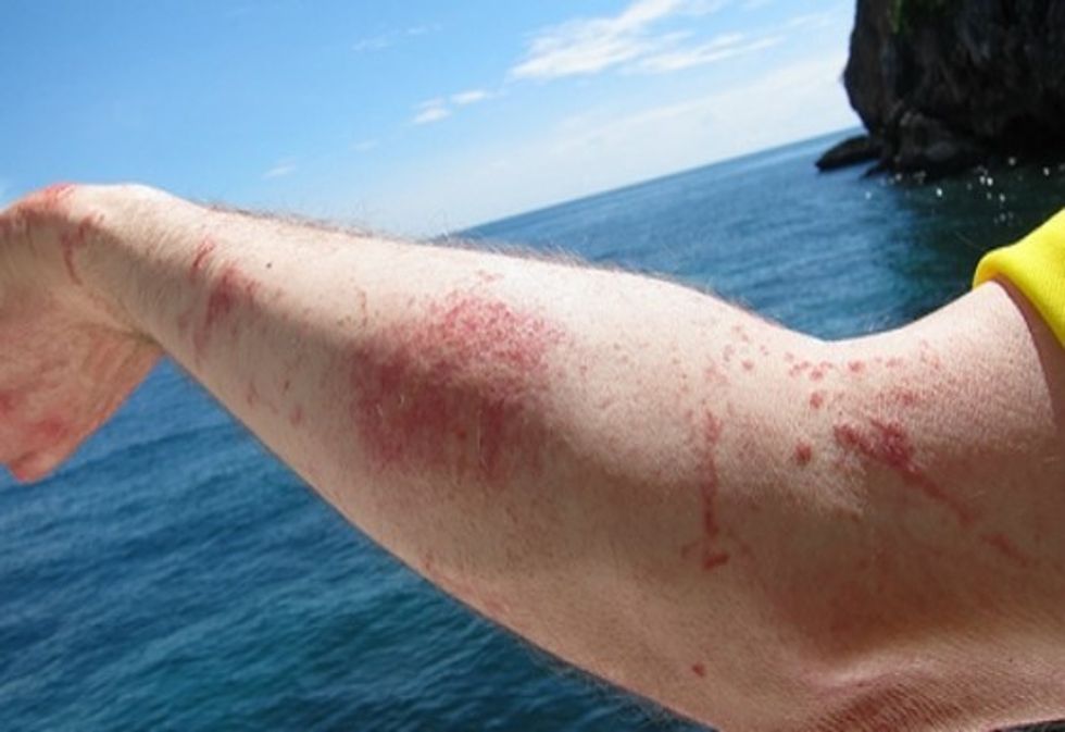 jellyfish sting on arm from OFA manual