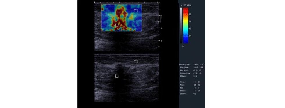 Karcinome lobulare invazive
