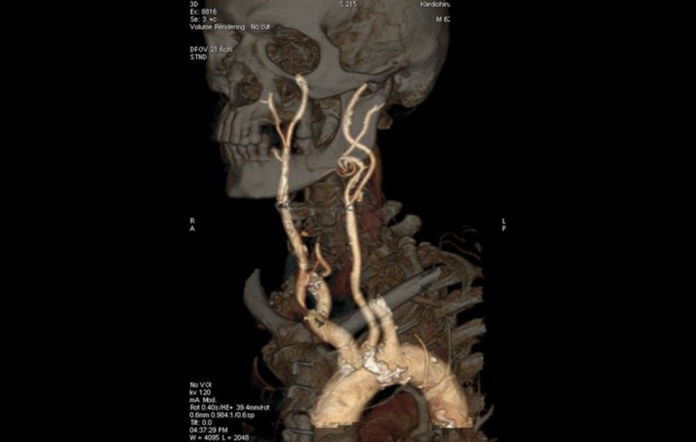 Karotidni arterii ZMC