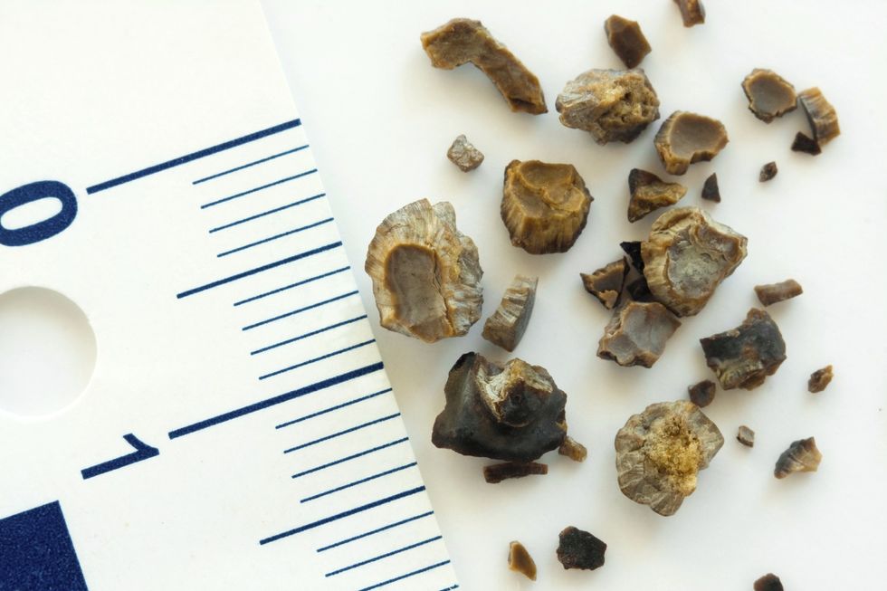 kidney stone image