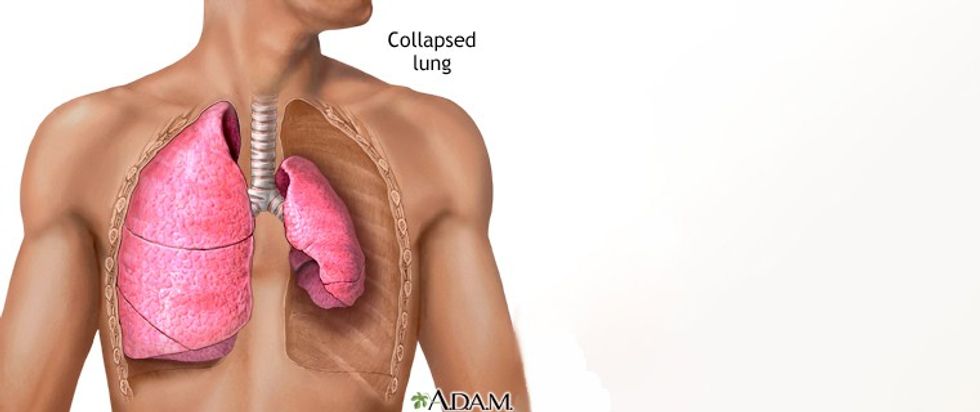 Kolapsi i mushkerive