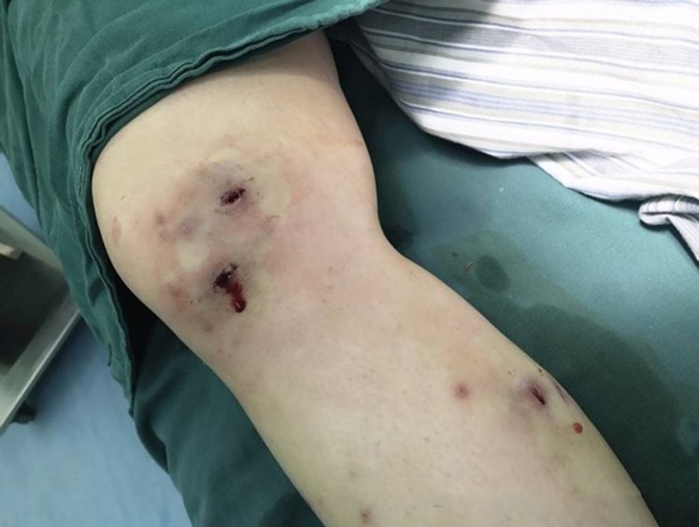 Kthehet nga shëtitja në natyrë nga kemba i dalin krimba misterioz foto 2