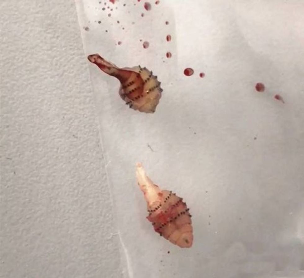 Kthehet nga shëtitja në natyrë nga kemba i dalin krimba misterioz foto 3