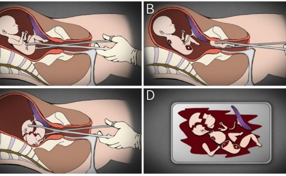 late term 810 500 75 s c1