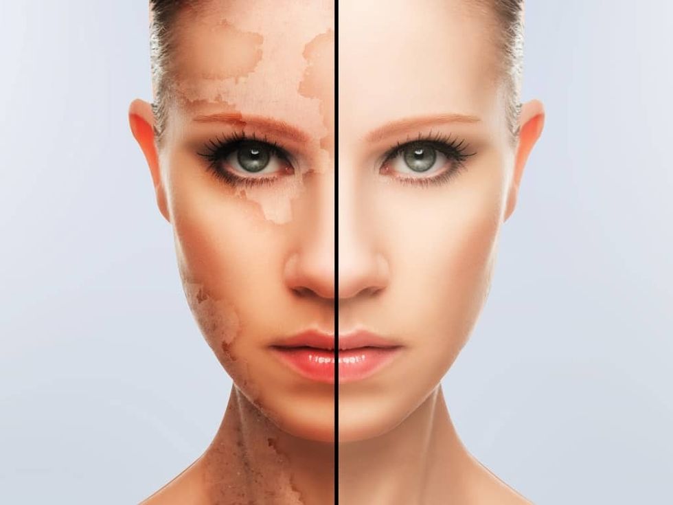 leucoderma-treatment