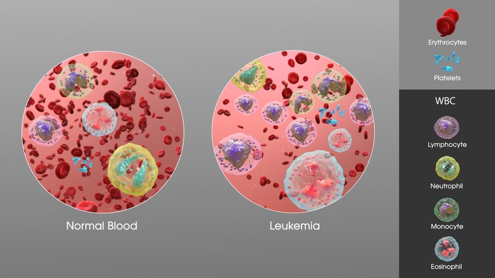 Leukemia SAG