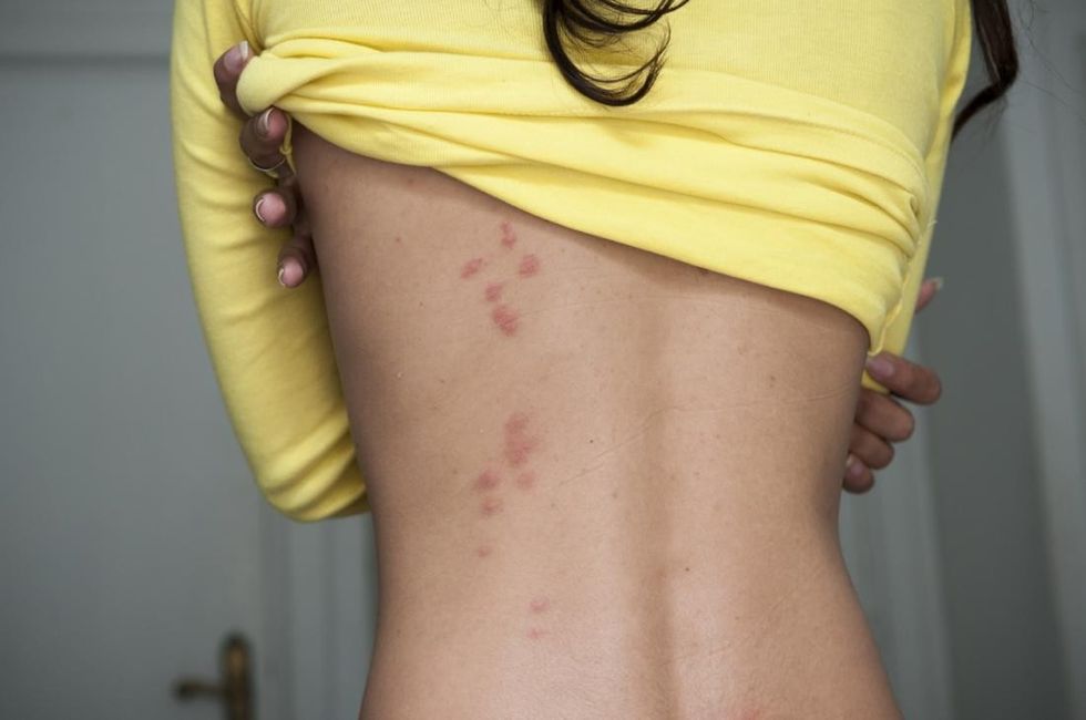 line of bedbug bites on a woman s back