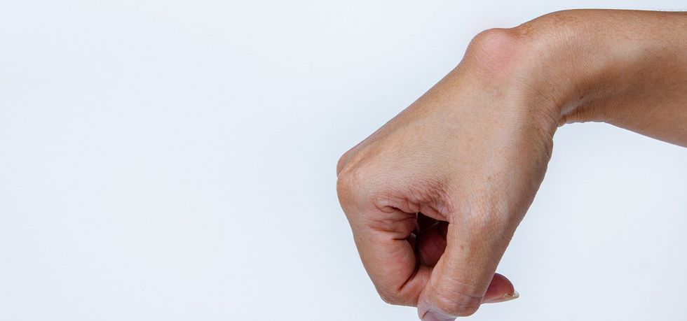 lipoma causes symptoms types removal tt