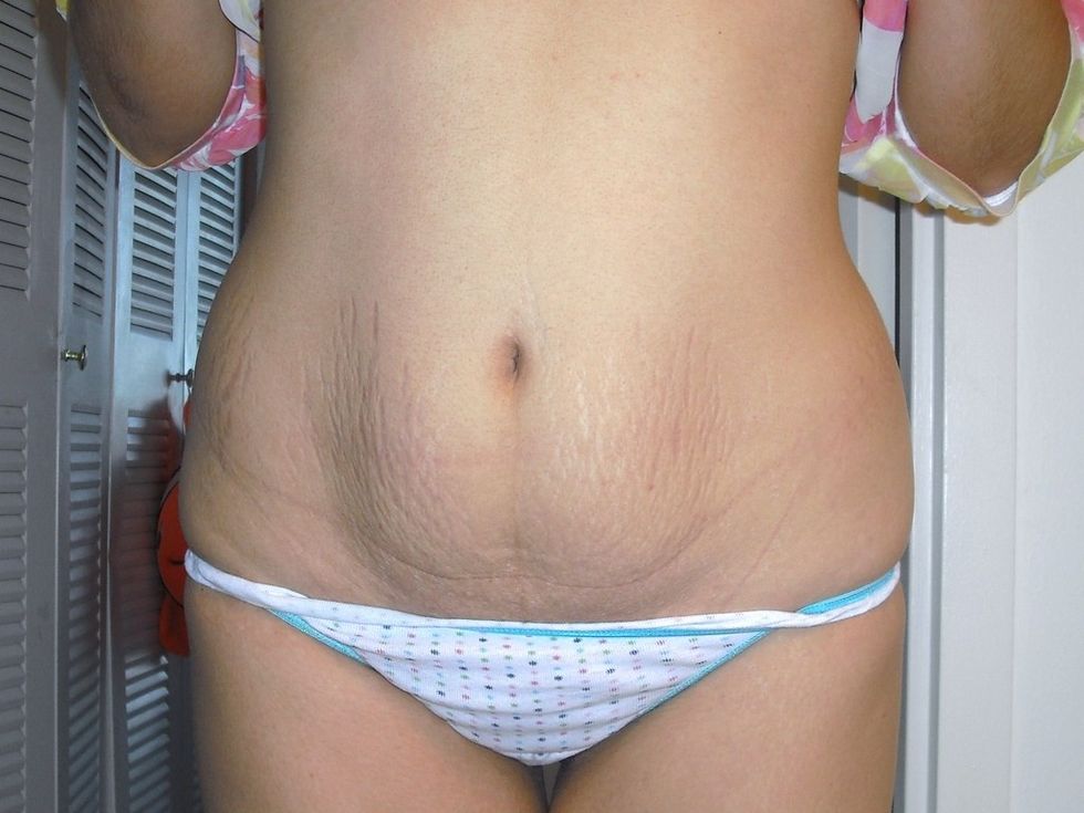 Loose Skin After Pregnancy