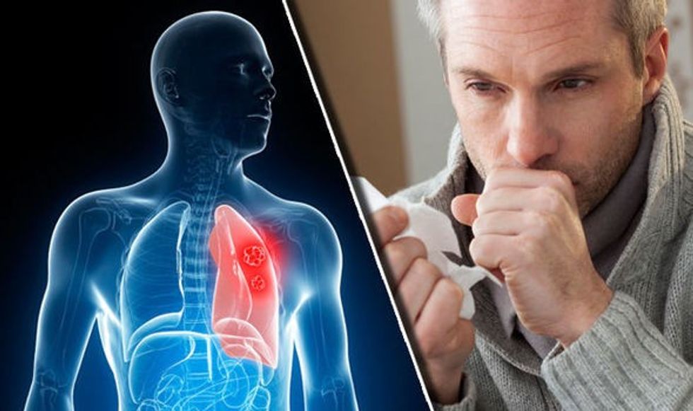 Lung cancer symptoms 865062
