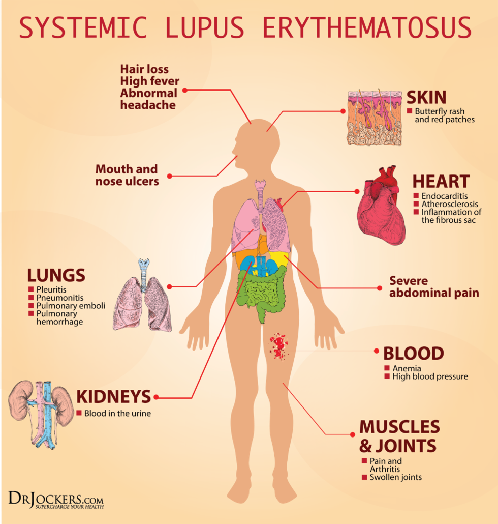 LUPUS Symptoms 1