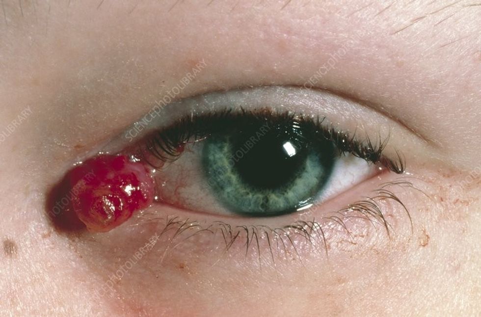 M1550199 Pyogenic granuoma of eye in young patient