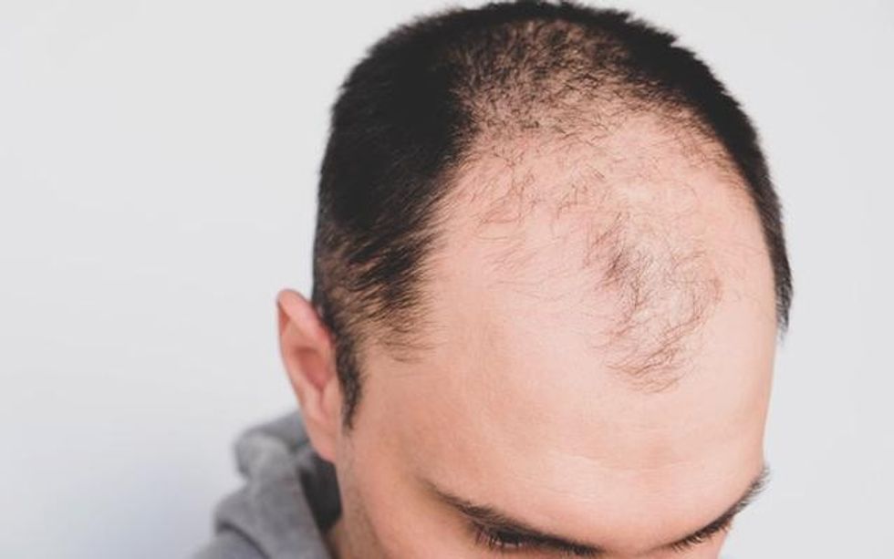 male baldness