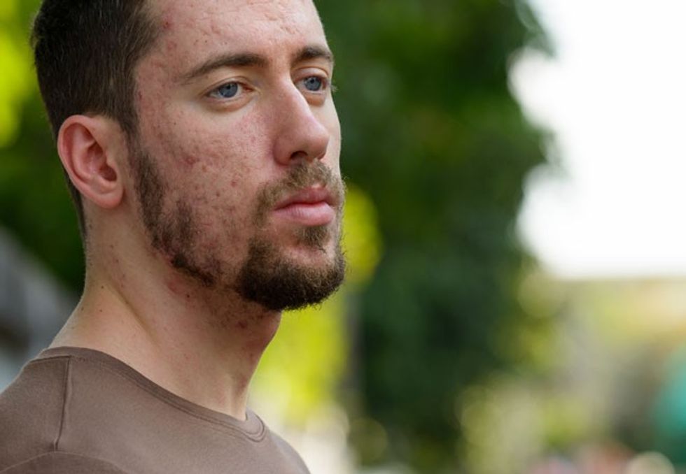 manAcneScarring1 668638960