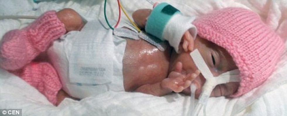 Mbijeton bebja e lindur me vetëm 230 gramë foto 2