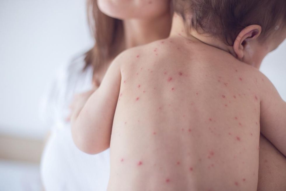 measles spot