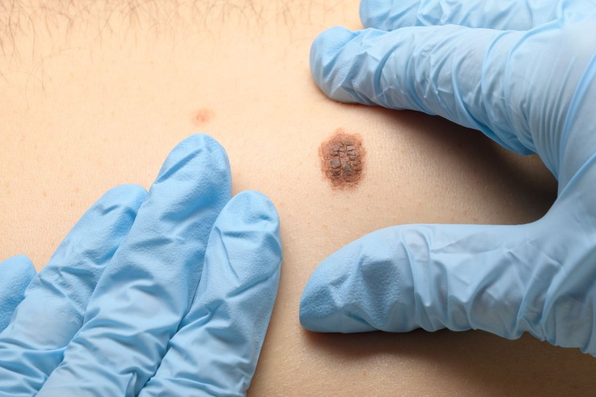 Dermatologët në Maqedoni zbulojnë raste të dyshimta të kancerit të lëkurës gjatë kontrolleve falas Dermatologët në Maqedoni zbulojnë raste të dyshimta të kancerit të lëkurës gjatë kontrolleve falas