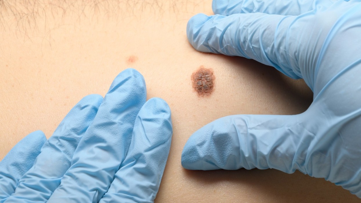 melanoma