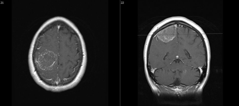 Meningeome e regjionit central