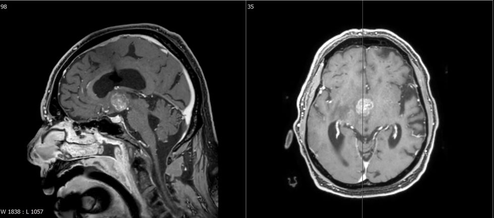 Metastaze ne ventrikulin e 3 te nga karcinoma uroteliale