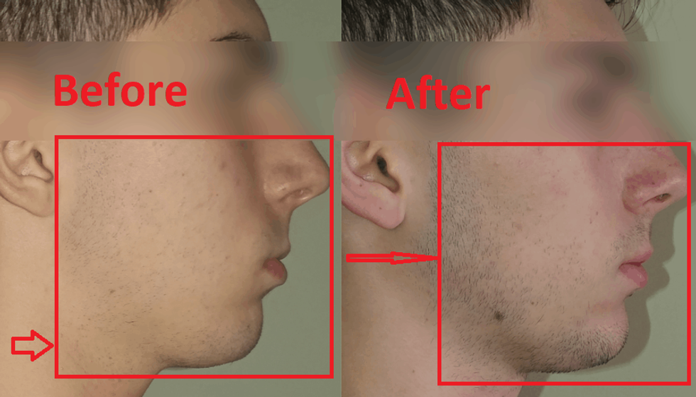 mewing progress for a 17 year old young man