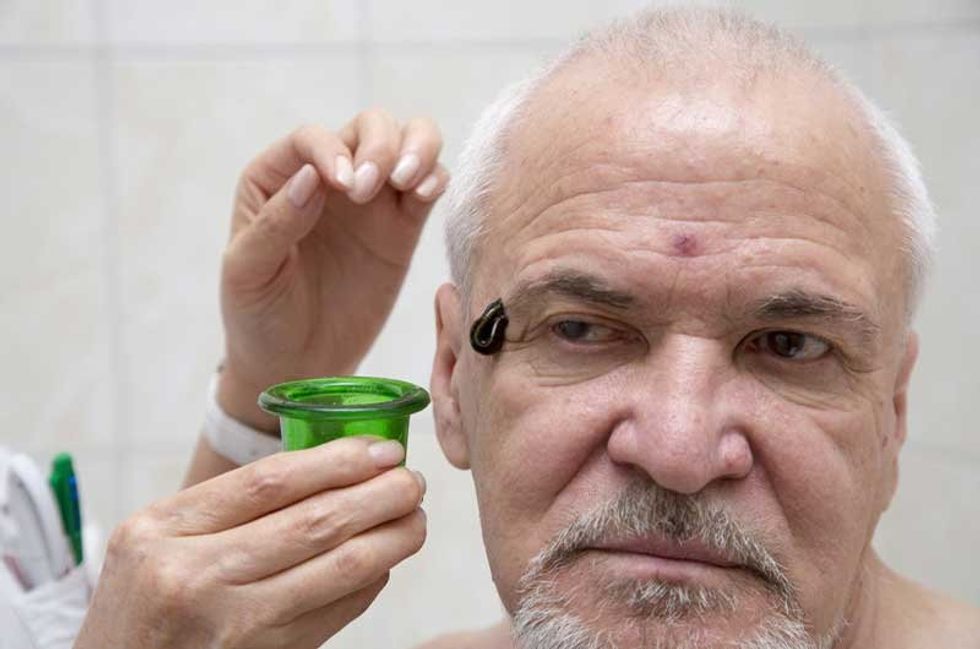 migraine headache leeches