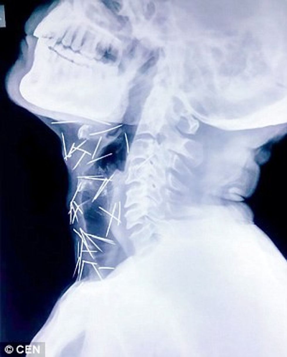 Mjekët gjetën 75 gjilpëra në duart kembet dhe qafen e pacientit foto 2