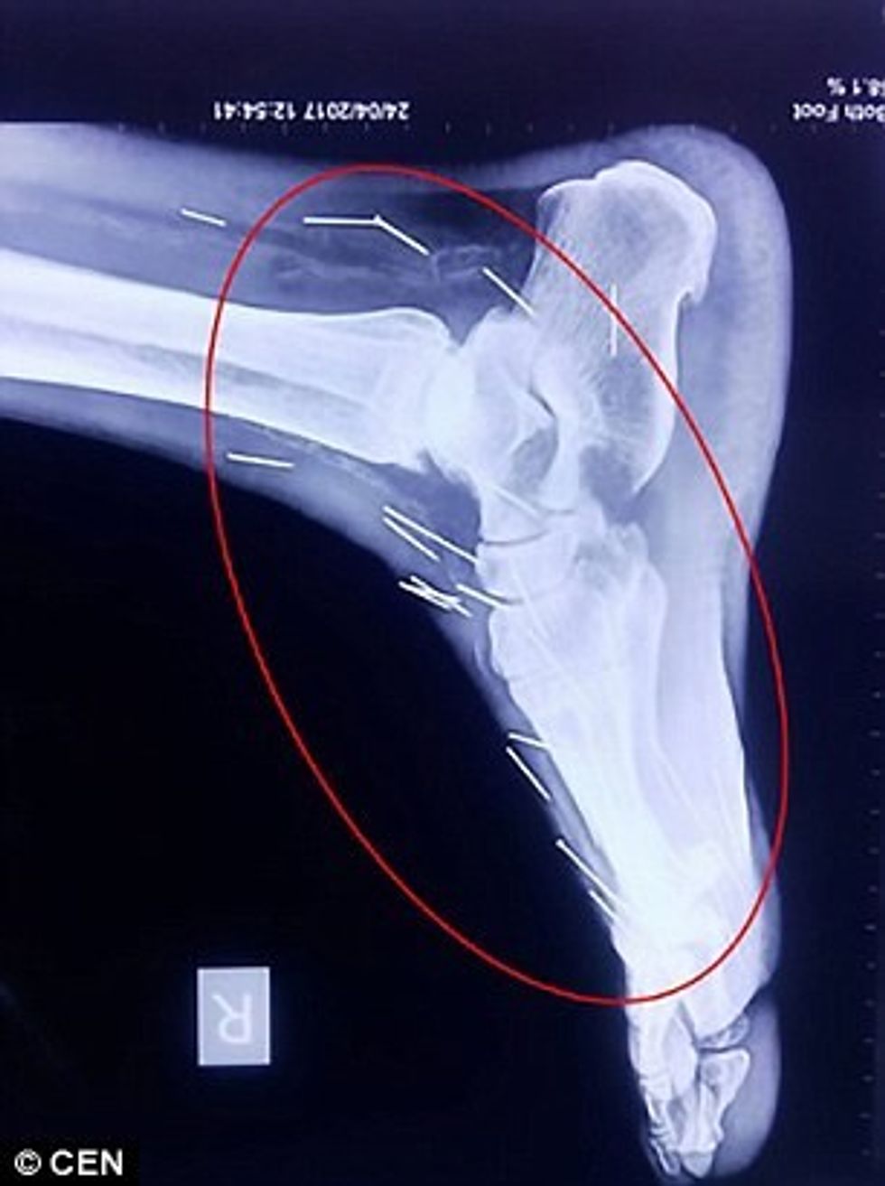 Mjekët gjetën 75 gjilpëra në duart kembet dhe qafen e pacientit foto 4