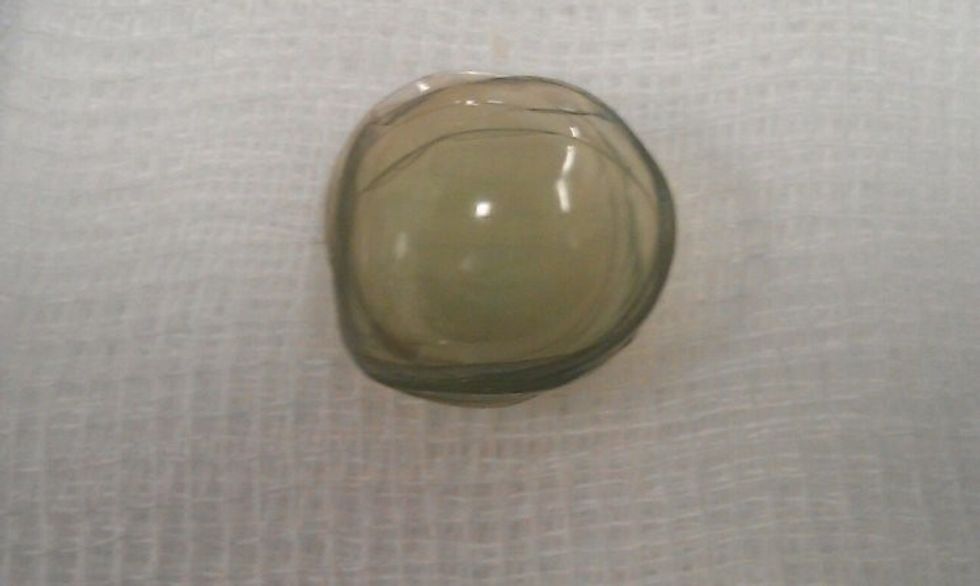 Mjekët i larguan nga syri 27 thjerrëza që i kishte futur për disa vite foto 2