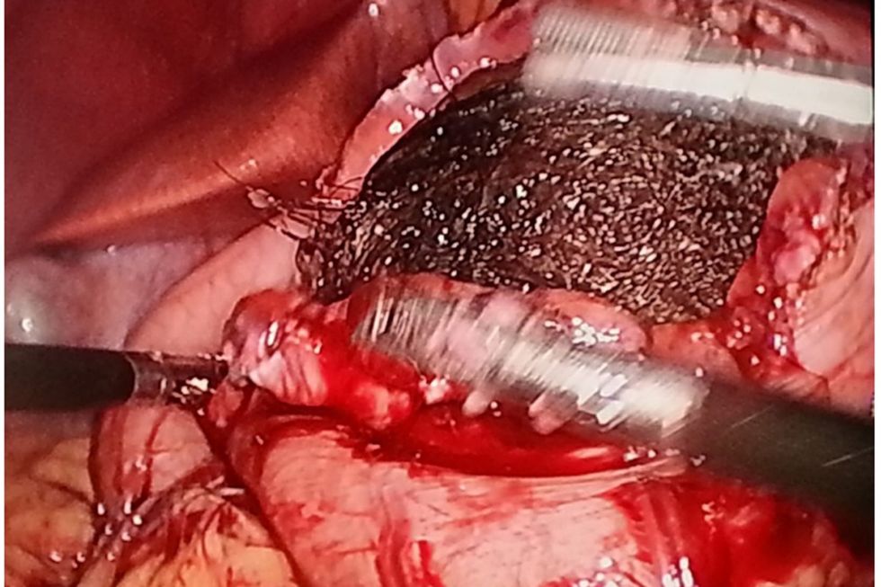 Mjekët i nxjerrin nga barku një lëmsh gjigant flokësh foto 3