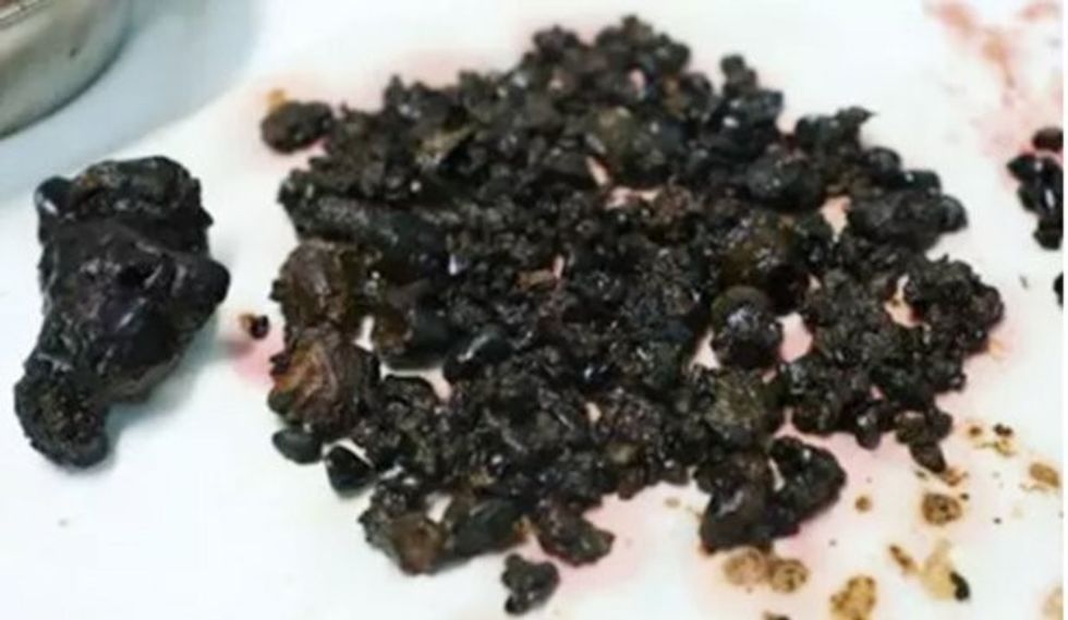 Mjekët ia largojnë më se 200 gurë tregojne arsyen e formimit te tyre foto 2