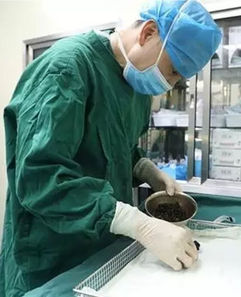 Mjekët ia largojnë më se 200 gurë tregojne arsyen e formimit te tyre foto 3