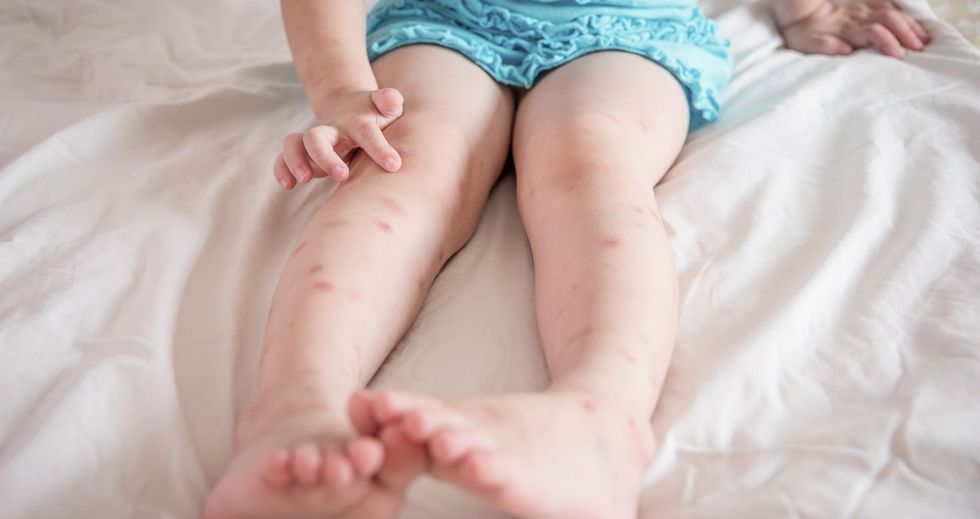 mosquito bites sore on child legs picture id653481788