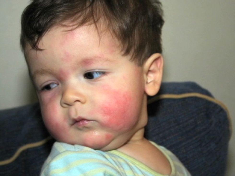 natpkg.food .allergies.101.cnn .