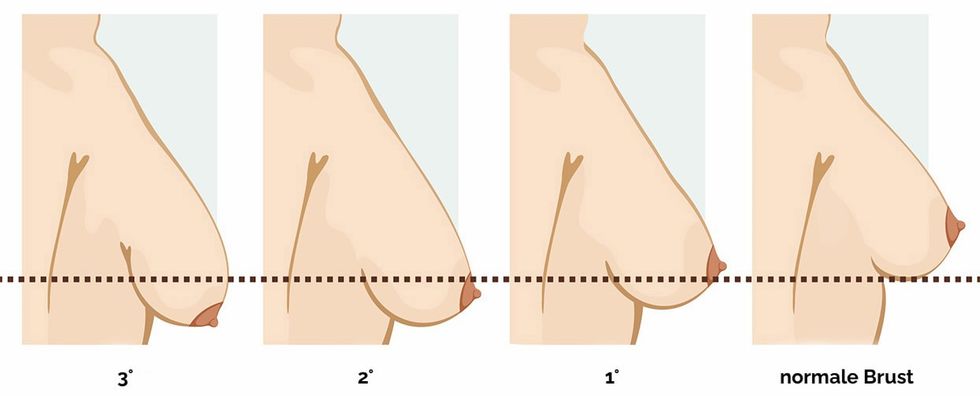 Ndryshime ne formen ose madhesine e gjirit 123