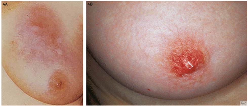 Ndryshime te lekures se gjirit