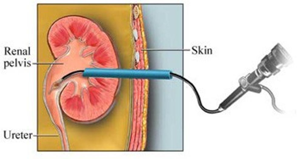nefrolitotomia perkutane