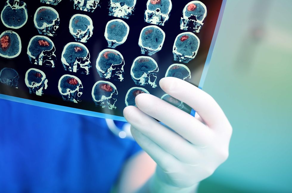 new brain implant for Parkinsons Disease