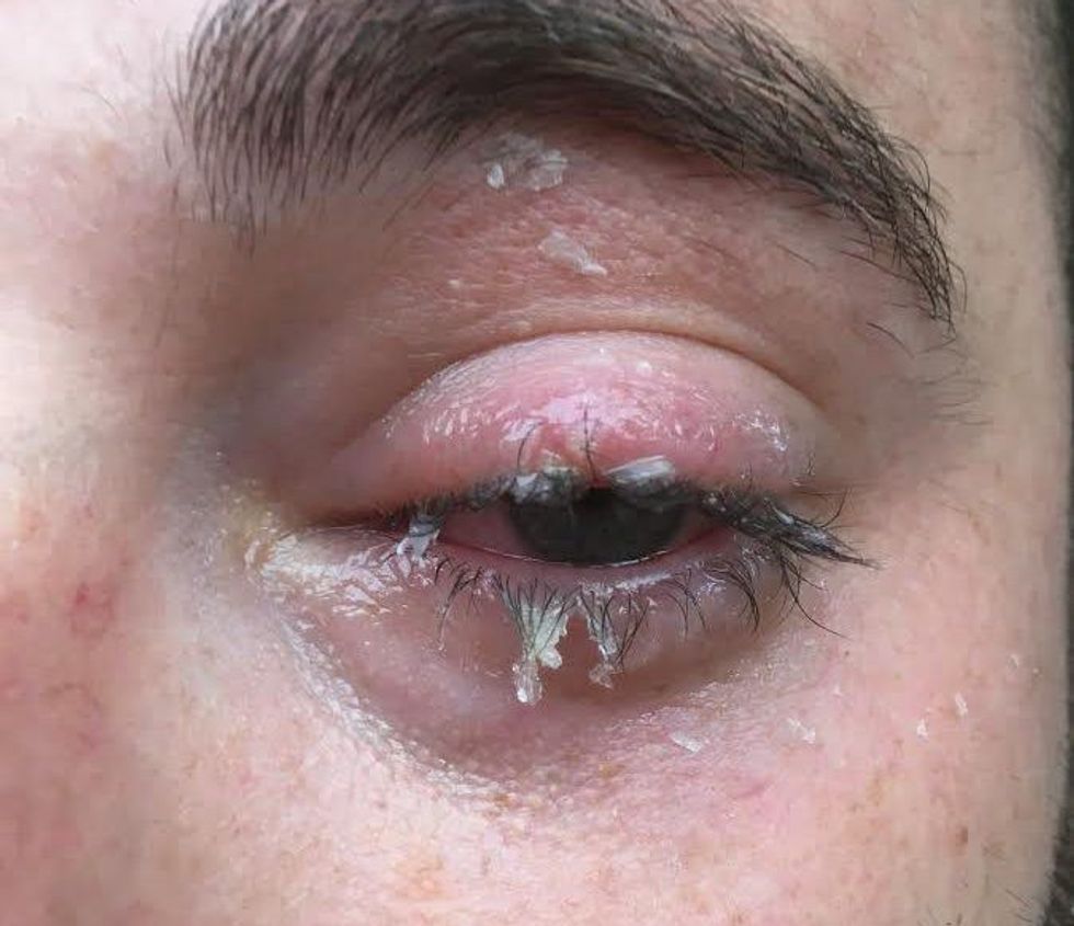 ngjiti-kapaket-e-syrit-duke-perdorur-supe-ngjitesin-pa-kujdes-foto-3