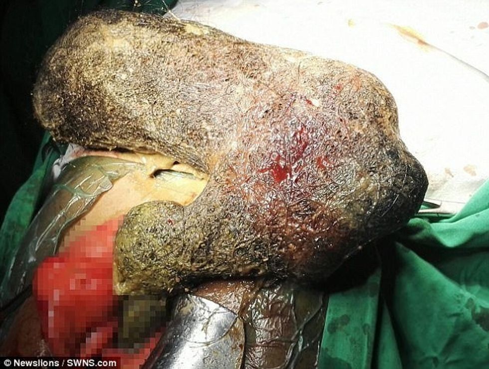 Nuk ndalonte së ngrëni flokët e veta mjeket i nxjerrin lemshin prej nje kilogrami foto 3