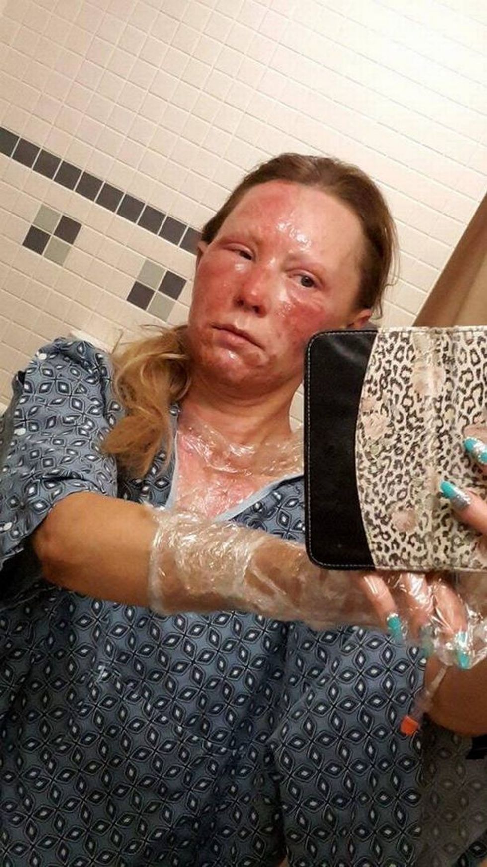 Nxjerrja e zjarrit nuk shkoi si duhet pesoi djegie te medha perfshire edhe syte foto 2