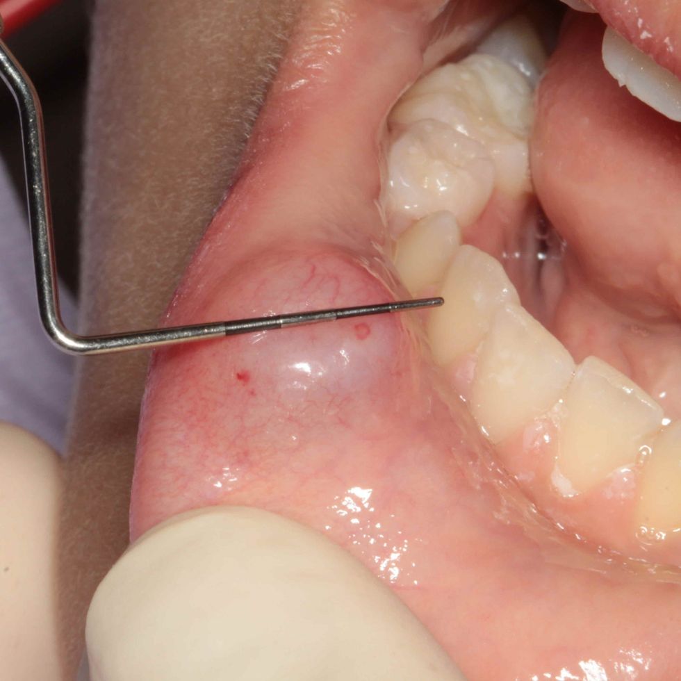 oralcavitymucoceleLee01