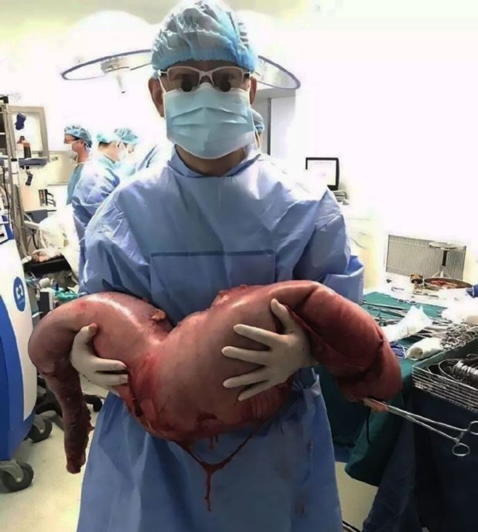 Pacientit që vuante nga kapsllëku i hoqen nga zorra masen gjigante foto 2