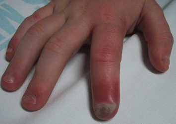 Paediatric paronychia