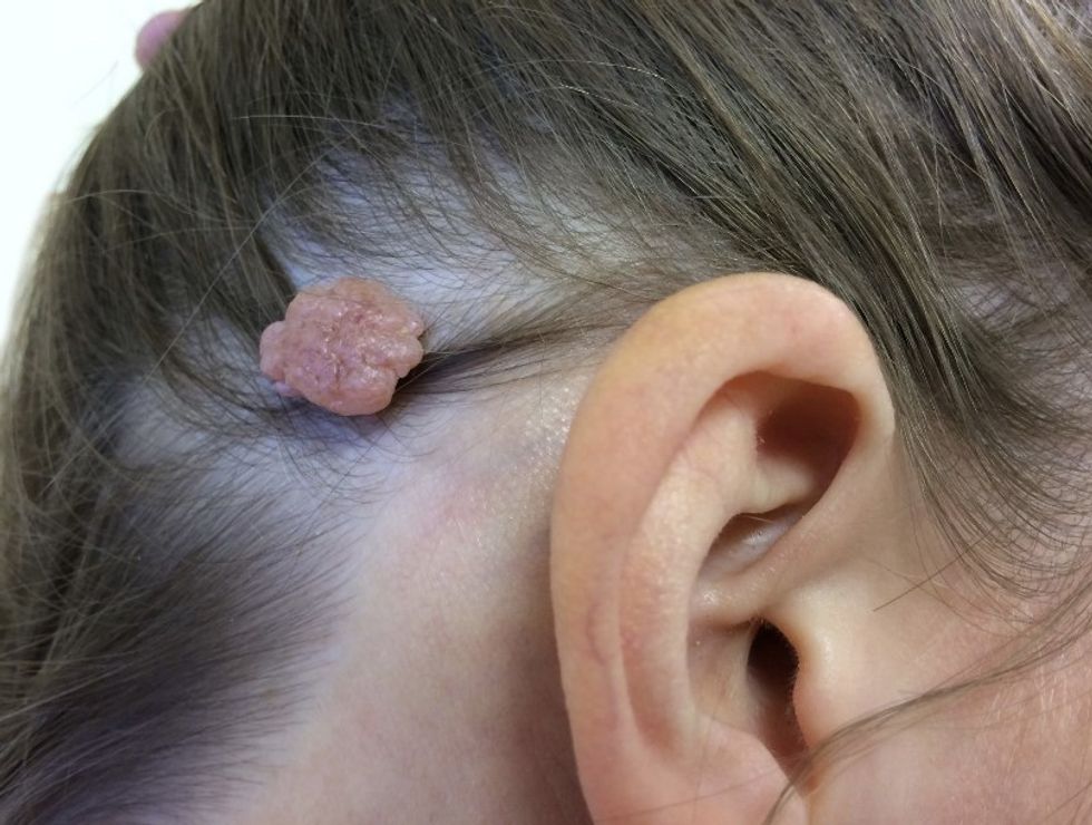 Papilloma scalp